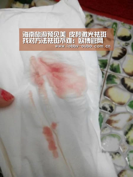海南旅游预见美 皮秒激光祛斑 找对方法祛斑不难:欧博官网(图1) 欧博注册流程